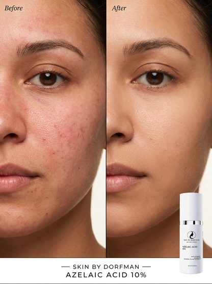 Azelaic Acid 10% My Store